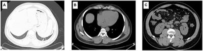 Patient with suspected co-infection of hemorrhagic fever with renal syndrome and malaria: a case report